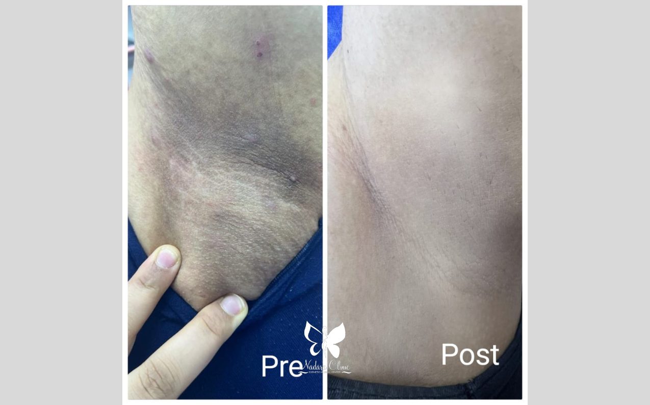 جلسات تفتيح البشرة في الغردقة